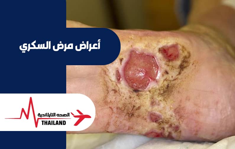علاج السكري وغرغرينا القدم في تايلاند
