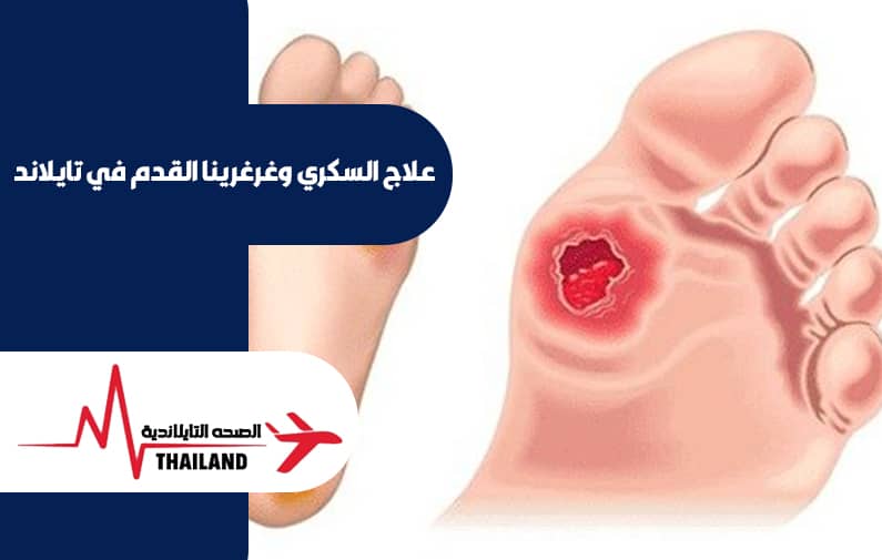 علاج السكري وغرغرينا القدم في تايلاند