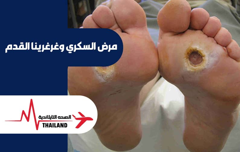 علاج السكري وغرغرينا القدم في تايلاند